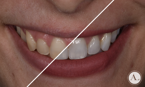 Casos resueltos Blanqueamiento Dental