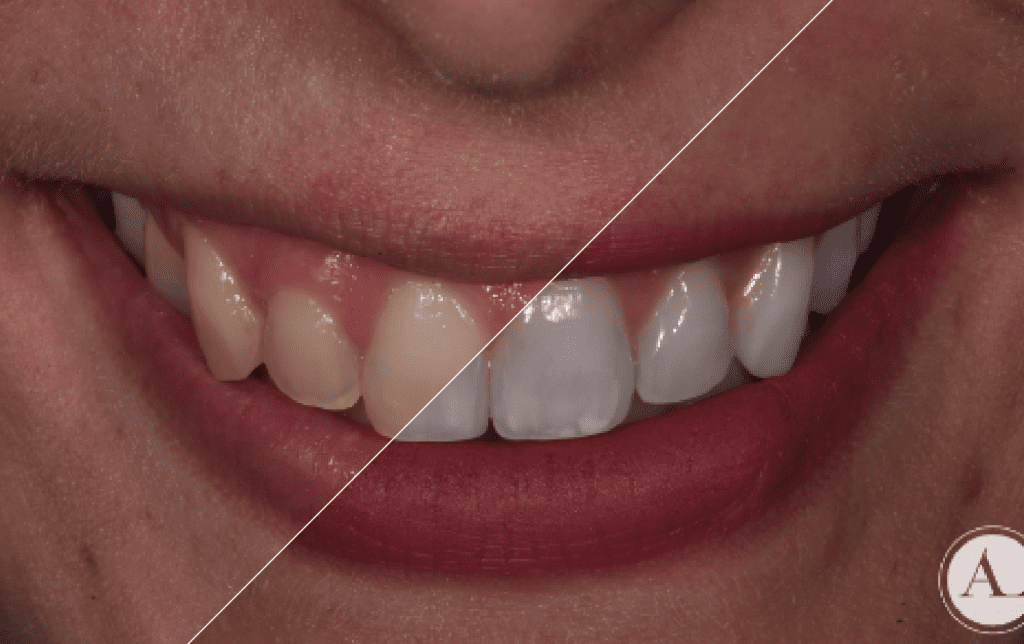 Riesgos y consecuencias de un blanqueamiento dental casero