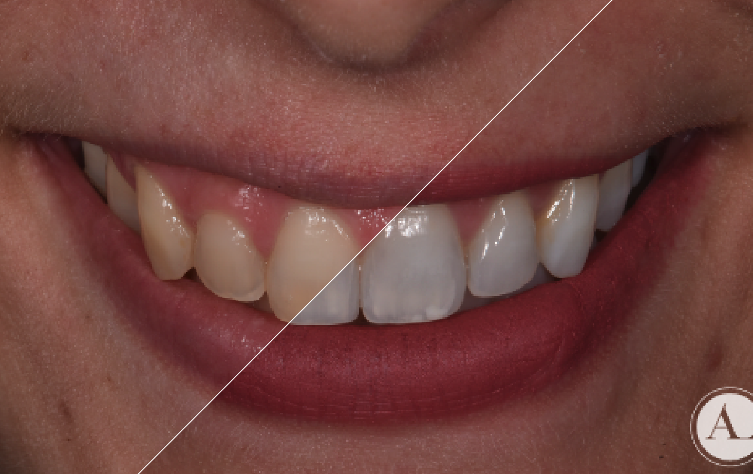 Riesgos y consecuencias de un blanqueamiento dental casero