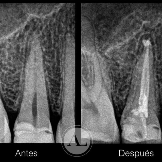 Endodoncia en Córdoba