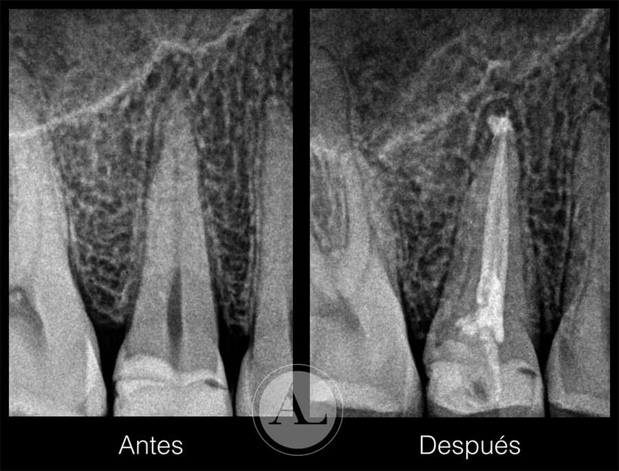 ¿Qué es una endodoncia y cuándo se necesita?