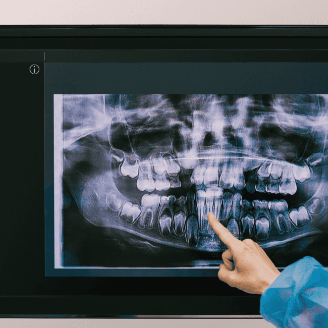 Beneficios del TAC dental y la imagen 3D en tratamientos
