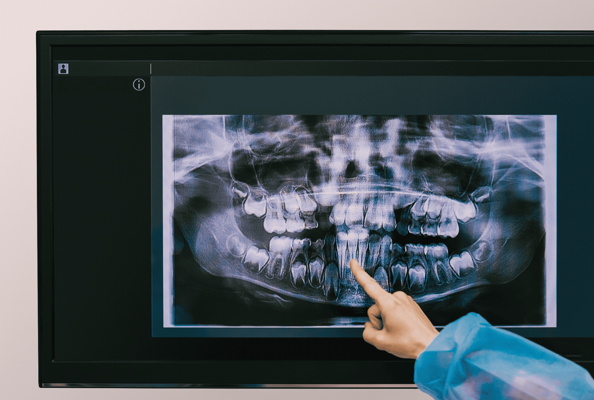 Beneficios del TAC dental y la imagen 3D en tratamientos