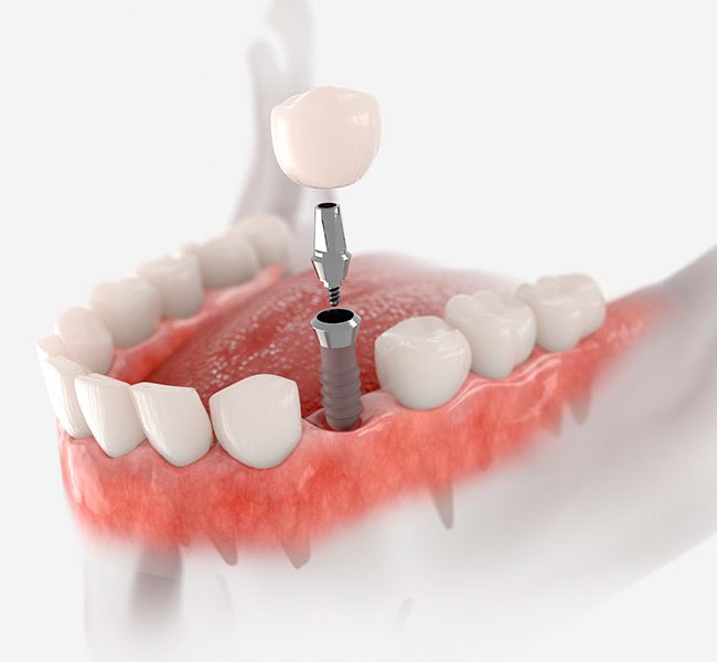 Implantes de carga inmediata en Córdoba