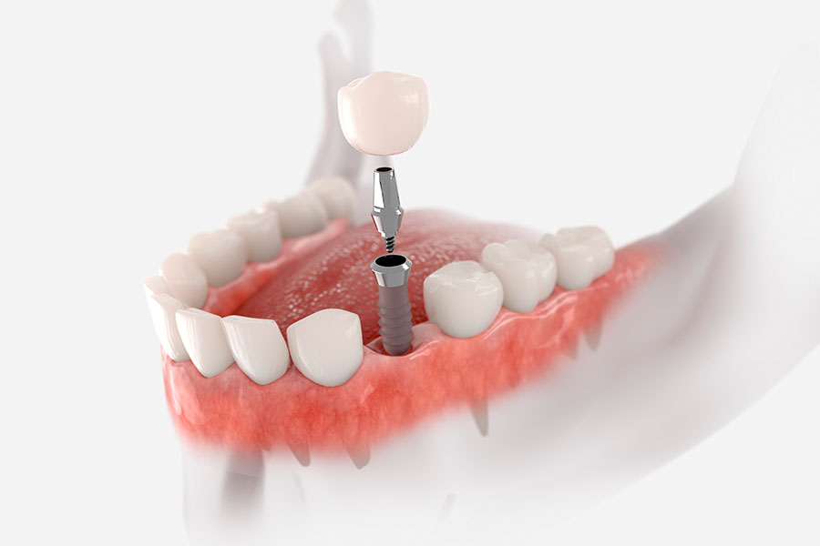 Implantes de carga inmediata en Córdoba