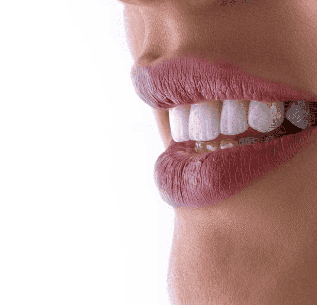 Carillas dentales y diseño de sonrisa