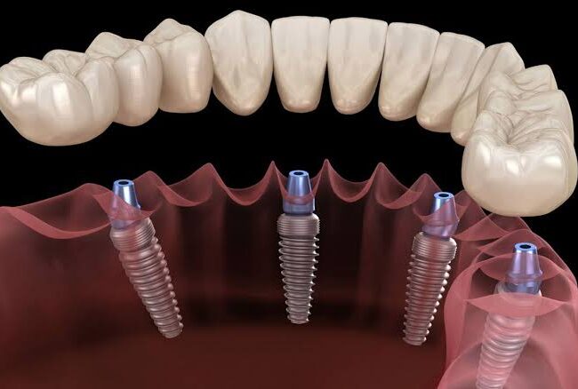 Implantes All on four en Córdoba