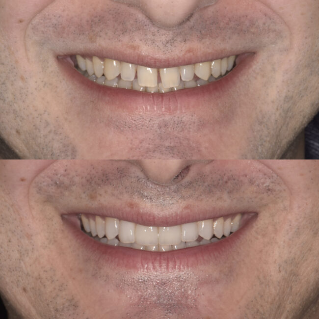 Descubre nuestras carillas dentales de alta estética
