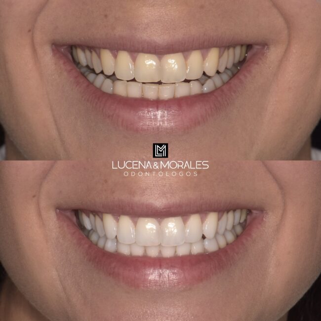 Tratamientos de blanqueamiento dental en Córdoba