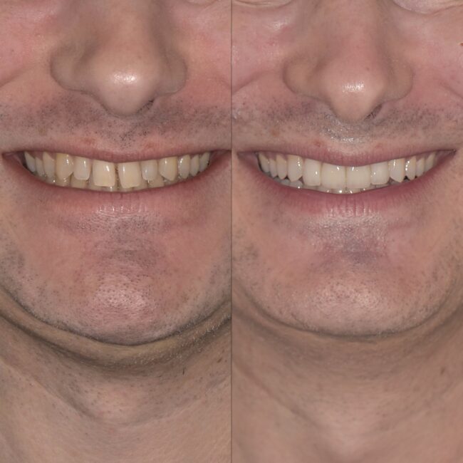 Carillas dentales Córdoba