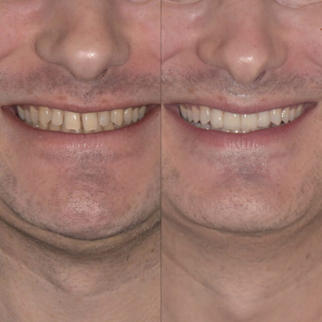 Carillas dentales Córdoba